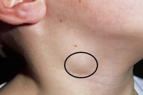 Bệnh lao hạch có nguy hiểm không?