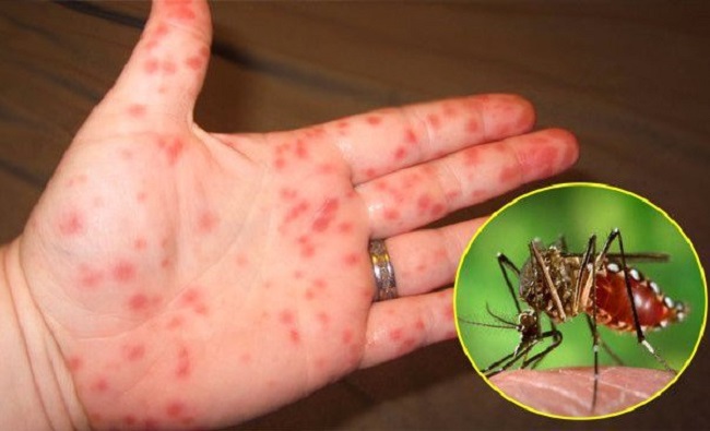 Các triệu chứng của sốt xuất huyết là gì?