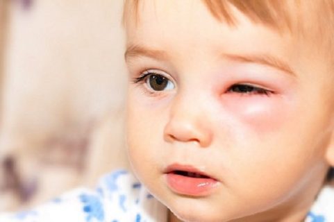 Cách chữa đau mắt cho trẻ sơ sinh