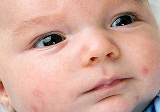 Trẻ sơ sinh nổi mụn trên mặt có nguy hiểm không?