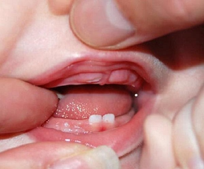 dấu hiệu mọc răng ở trẻ sơ sinh