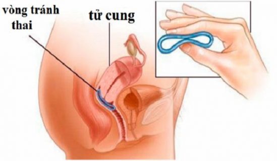 Những biện pháp tránh thai sau quan hệ