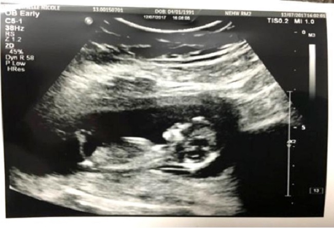 Chiều dài đầu mông thai 12 tuần của bé