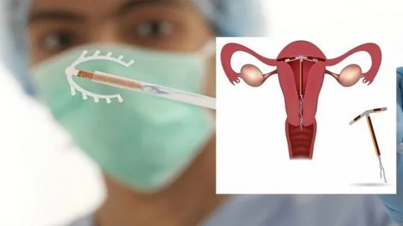 Đặt vòng tránh thai sau sinh mổ có được không?